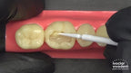 Tetric N-Bond Universal – single-component light-cured adhesive for direct and indirect restorations