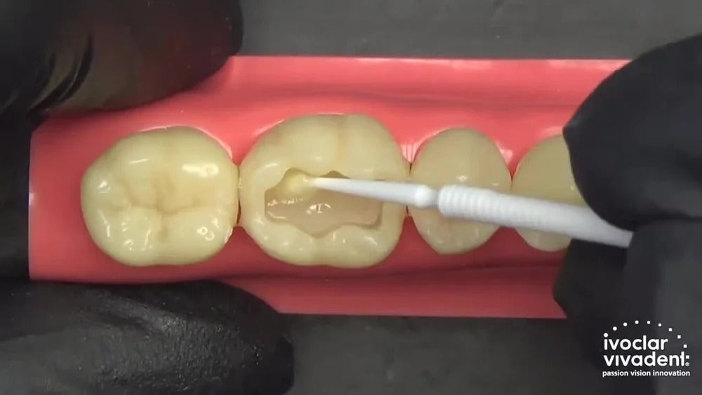 Tetric N-Bond Universal – single-component light-cured adhesive for direct and indirect restorations