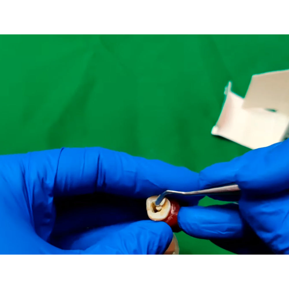 Dentist applying 3M ESPE Cavit-G temporary filling material into tooth cavity using plugger - clinical demonstration
