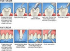 Omnichroma Dental Composite – Direct Veneer, Diastema Closure, Porcelain Repair