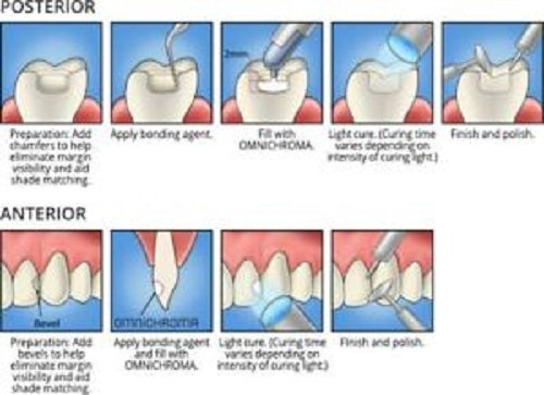 Omnichroma Dental Composite – Direct Veneer, Diastema Closure, Porcelain Repair