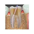 Prime Dental Bioceramic Sealer – Biocompatible MTA Root Canal Obturation Material