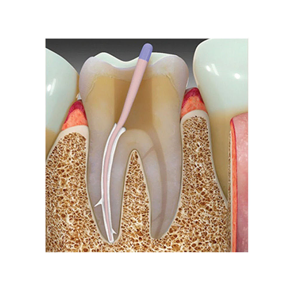Prime Dental Bioceramic Sealer – Biocompatible MTA Root Canal Obturation Material