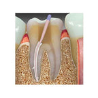 Prime MTA Bioceramic Root Canal Sealer – 3g Syringe & 15 Capillary Tips - KedarCart