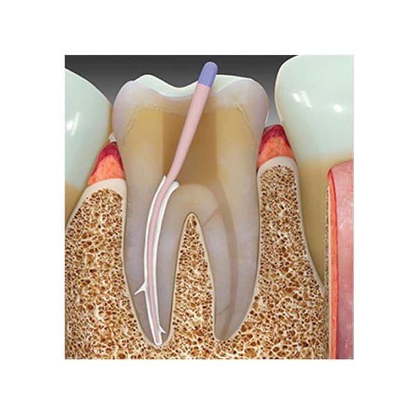 Prime MTA Bioceramic Sealer – trusted MTA based root canal sealer for permanent obturation and apical seal by endodontists and dental professionals globally
