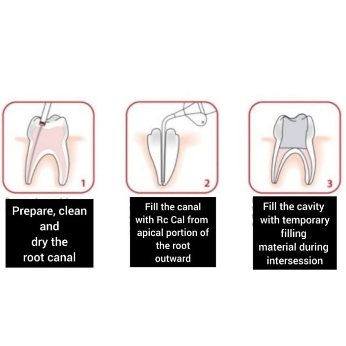 RC Cal Calcium Hydroxide Paste 3-Step Application Guide - Prepare Clean Fill Root Canal
