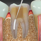 SafeEndo BioActive RCS Application – Bioactive Root Canal Sealer for Single Cone Technique