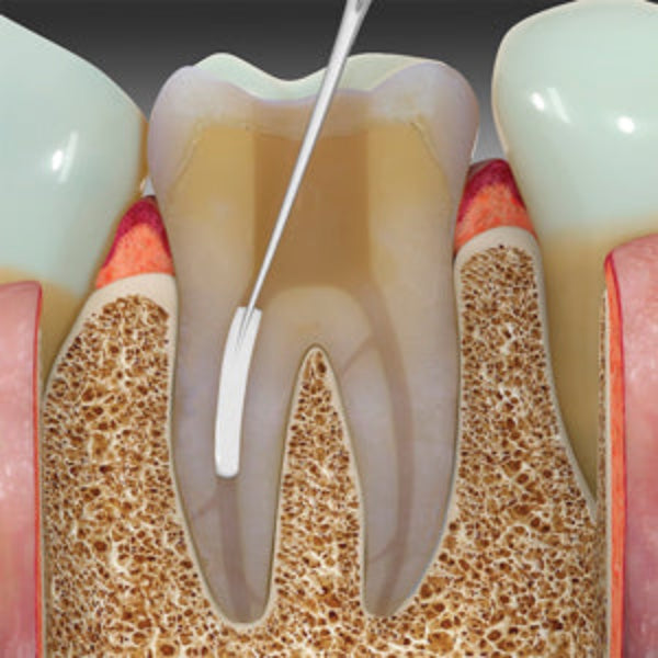 SafeEndo BioActive RCS Application – Bioactive Root Canal Sealer for Single Cone Technique