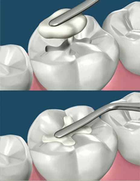 GC Solare X nano-hybrid composite enhanced radiopacity excellent shade blending anterior posterior