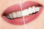 Ammdent Ultra White Teeth Bleaching System – Office & Home Use | Carbamide Peroxide Whitening