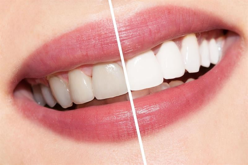 Ammdent Ultra White Teeth Bleaching System – Office & Home Use | Carbamide Peroxide Whitening