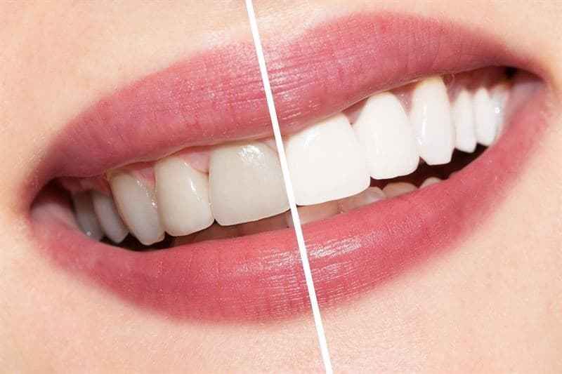 Ammdent Ultra White – 22% Home Bleaching 4-6 Sessions 35% Office Bleaching 2-3 Sessions Dental Use
