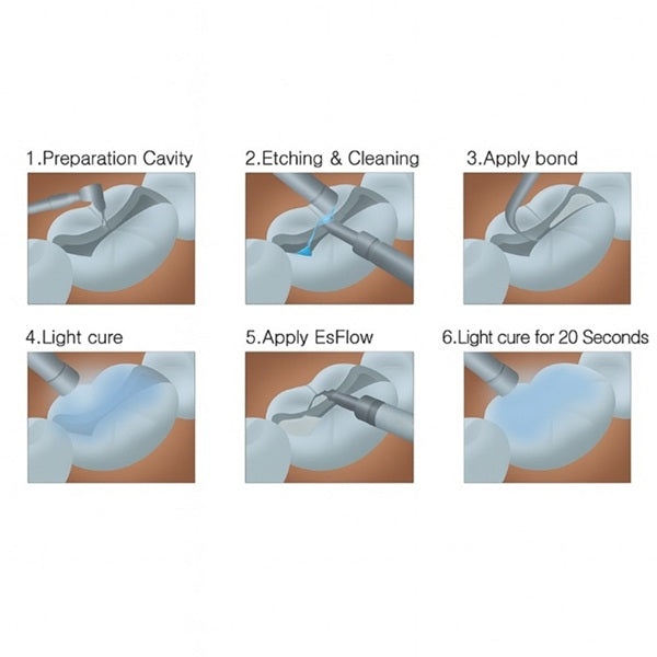 Voco Polofil NHT Flow Flowable Composite – 1.8g Nano-Hybrid Syringe for Reliable Anterior & Posterior Restorations Worldwide