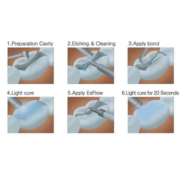 Voco Polofil NHT Flow – Veneer Repair Undercut Blocking Translucent Prosthetic Luting A1 A2 Shades
