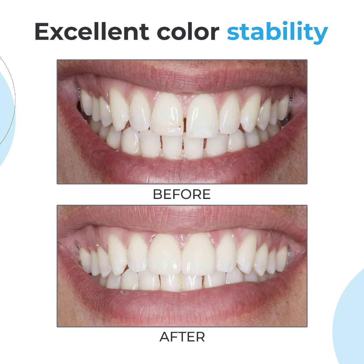 Waldent NanoFill Zirconium packable composite kit for anterior and posterior restorations