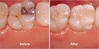 3M ESPE Filtek Z250 XT – Nano Hybrid Bis-GMA UDMA TEGDMA Silane Treated Silica Filler 61% Vol
